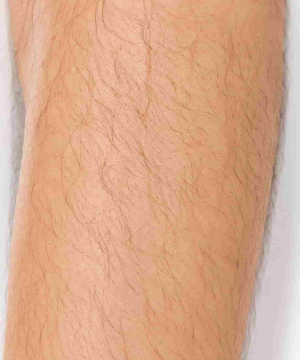 Before treatment